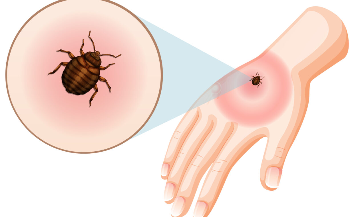 Bed bug bites sting on skin